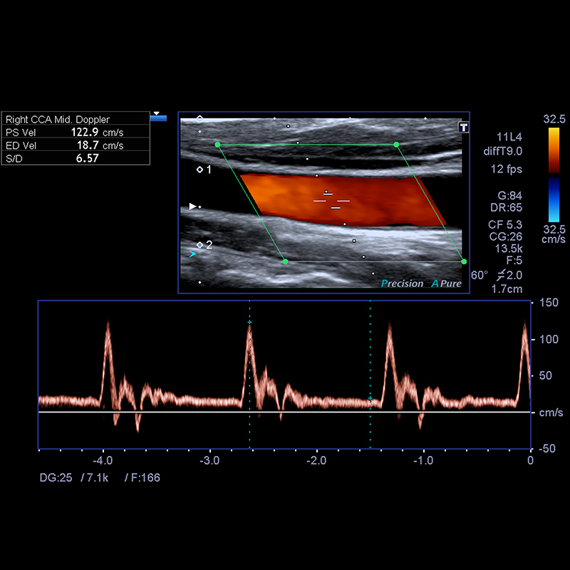 Echo-doppler des troncs supra aortiques