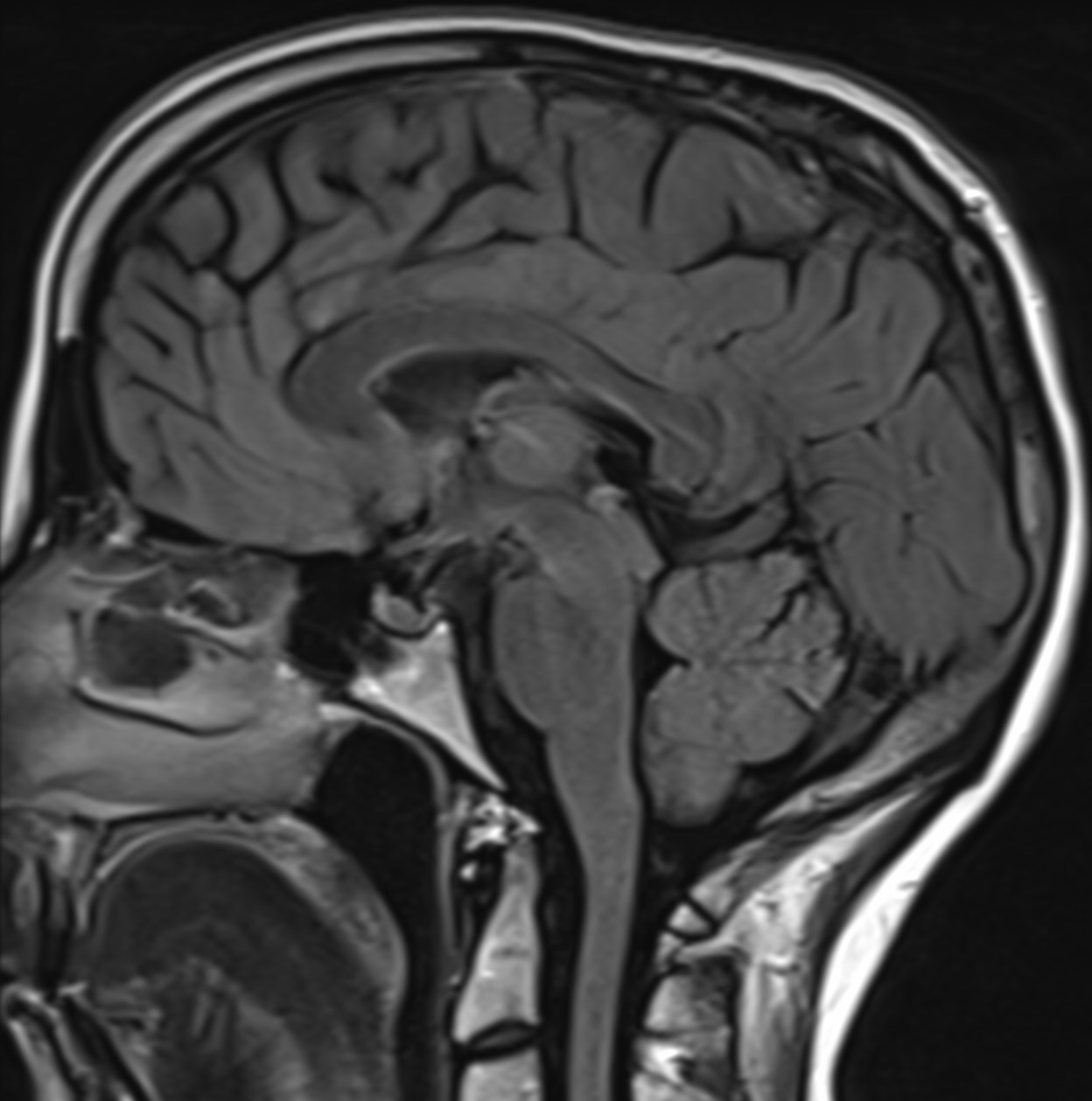 IRM cérébrale