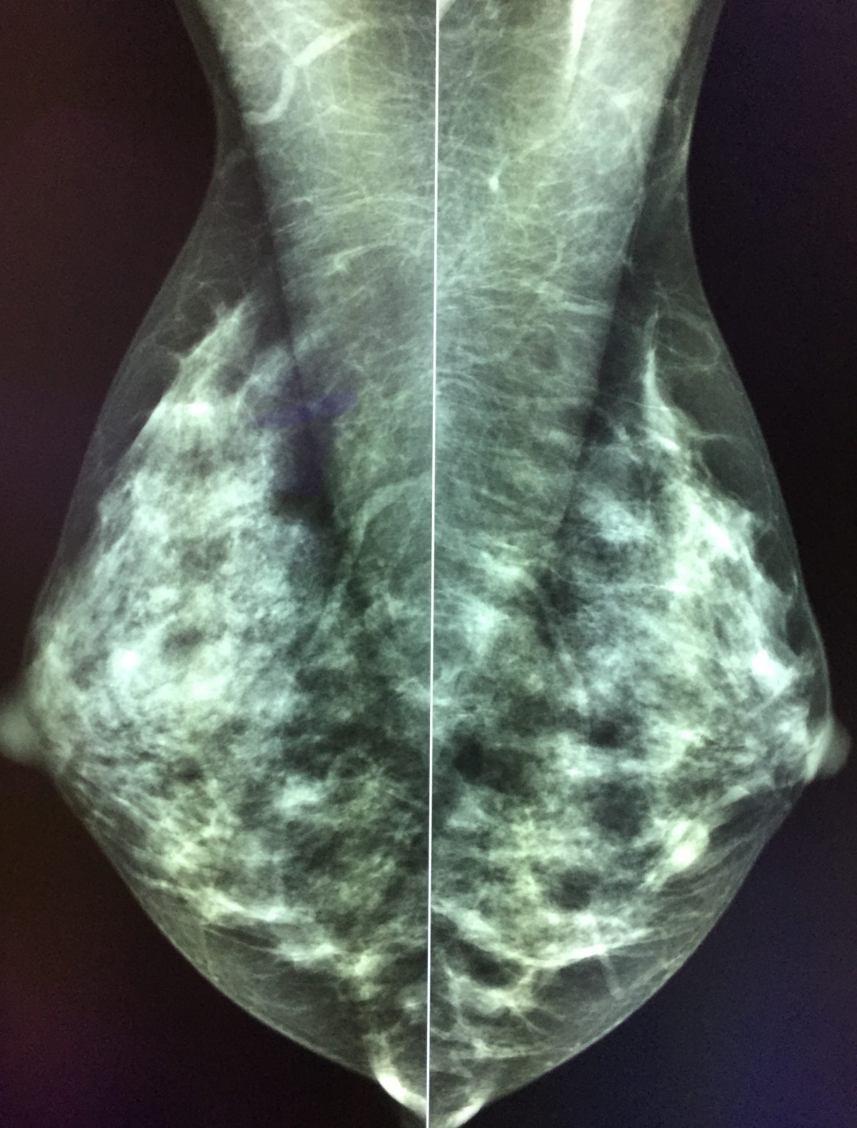 mammographie-1200x1579.jpg