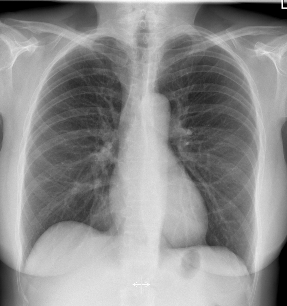 Radiographie du thorax