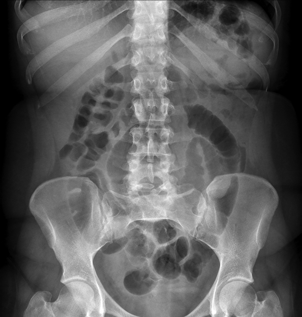 Radiographie - Abdomen sans préparation ASP