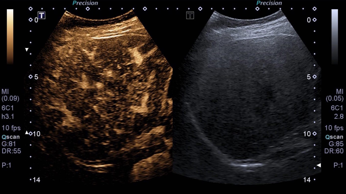 Echographie de constraste