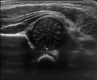 Luxation Congenitale De La Hanche Cabinet De Radiologie Clemenceau