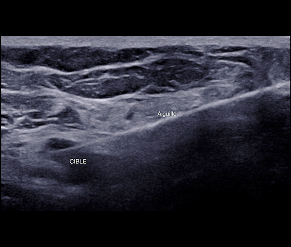 Microbiopsies mammaires