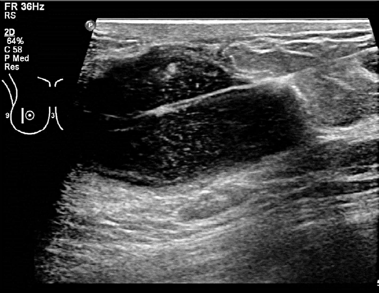 Microbiopsies des parties molles