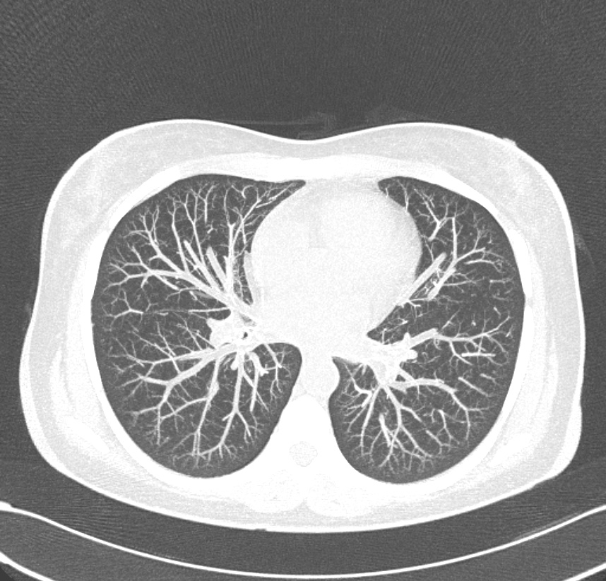 Scanner du thorax