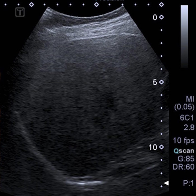 echographie-contraste-1