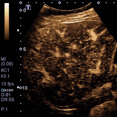 echographie-contraste-2