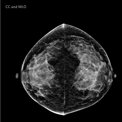 mammographie-image-1