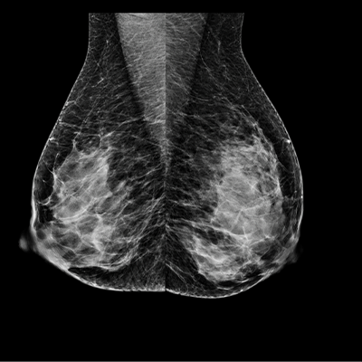 mammographie-image-2